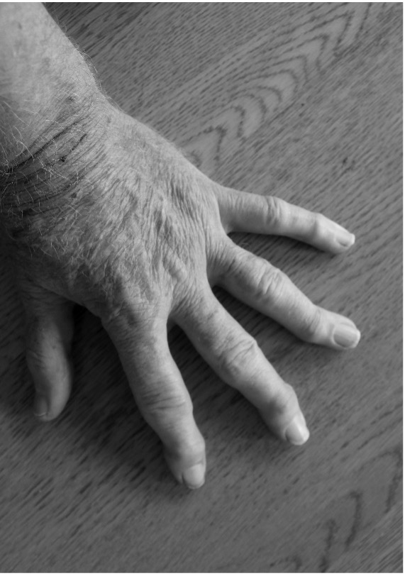 Paul's left hand. Not only are the knuckles swollen with arthritis, but they are twisting and contorted. His fingers bend away from each other.